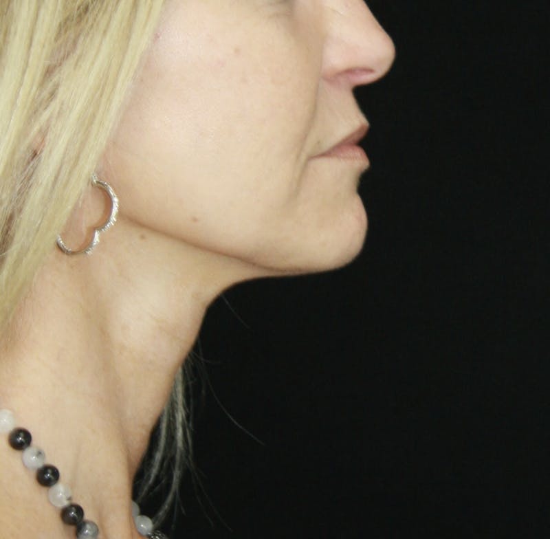 Facelift & Neck Lift Before & After Gallery - Patient 178281187 - Image 8