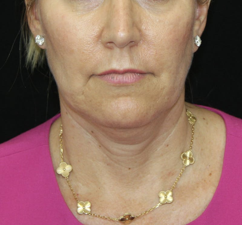Facelift & Neck Lift Before & After Gallery - Patient 178281204 - Image 1