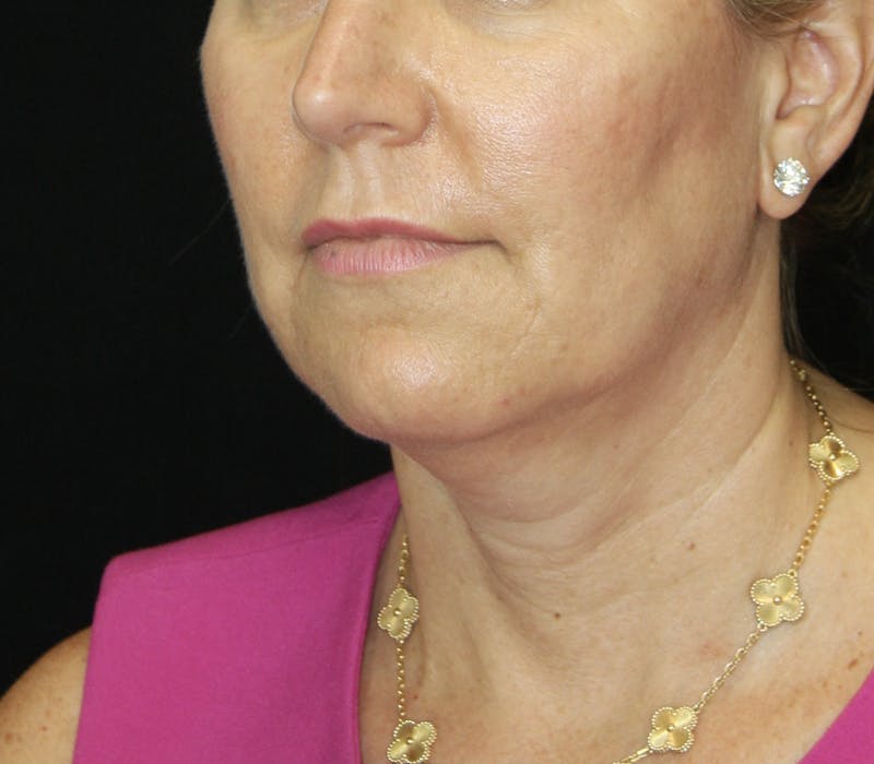 Facelift & Neck Lift Before & After Gallery - Patient 178281204 - Image 3