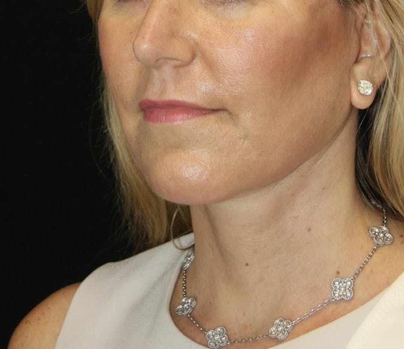 Facelift & Neck Lift Before & After Gallery - Patient 178281204 - Image 4