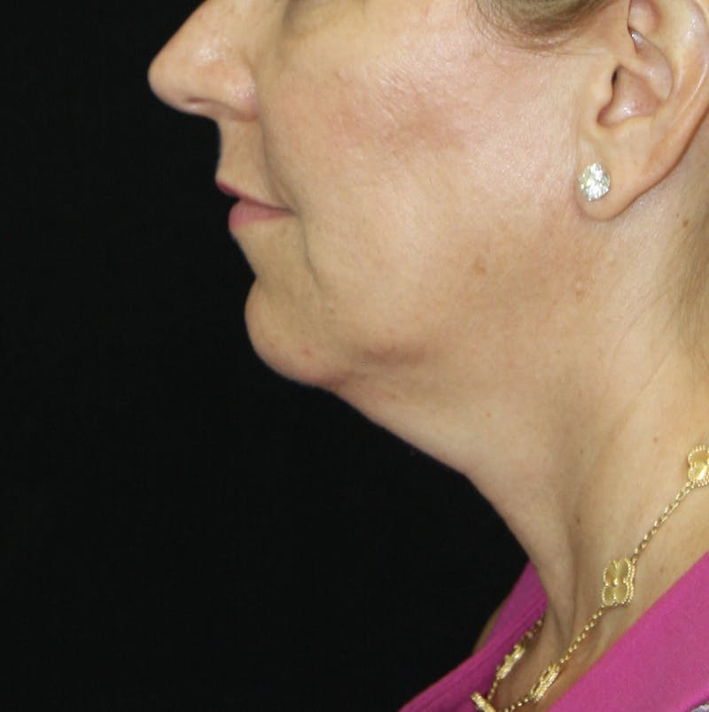 Facelift & Neck Lift Before & After Gallery - Patient 178281204 - Image 5
