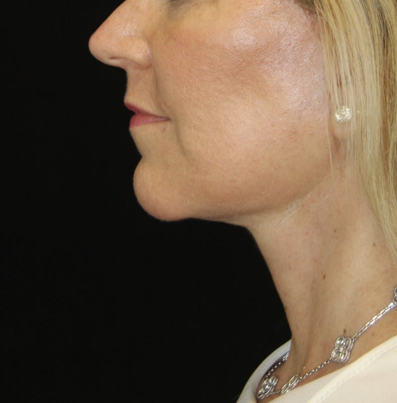 Facelift & Neck Lift Before & After Gallery - Patient 178281204 - Image 6