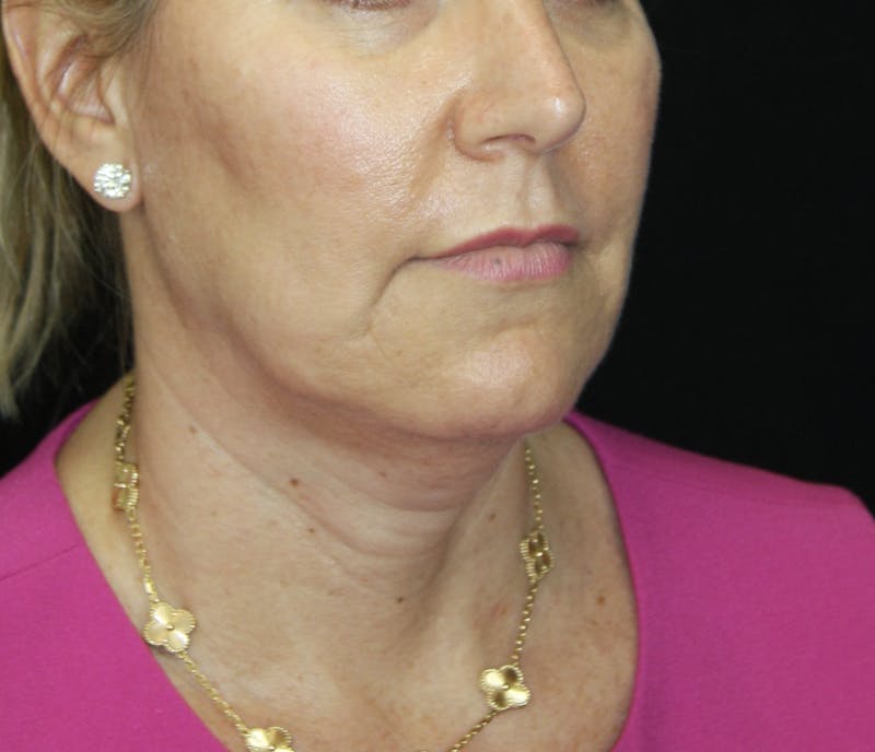 Facelift & Neck Lift Before & After Gallery - Patient 178281204 - Image 7