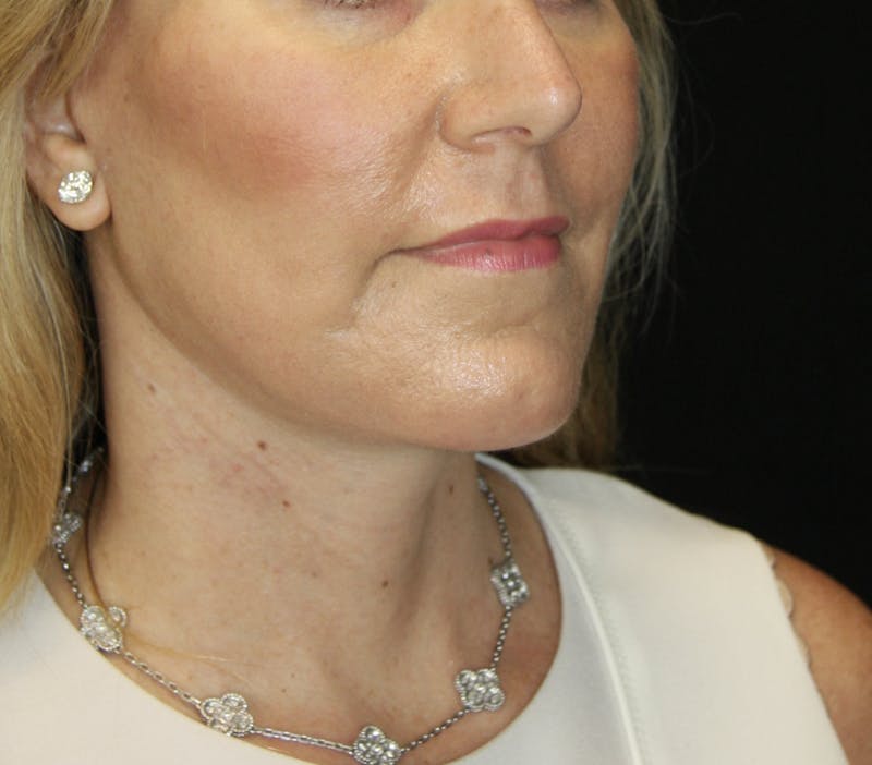 Facelift & Neck Lift Before & After Gallery - Patient 178281204 - Image 8