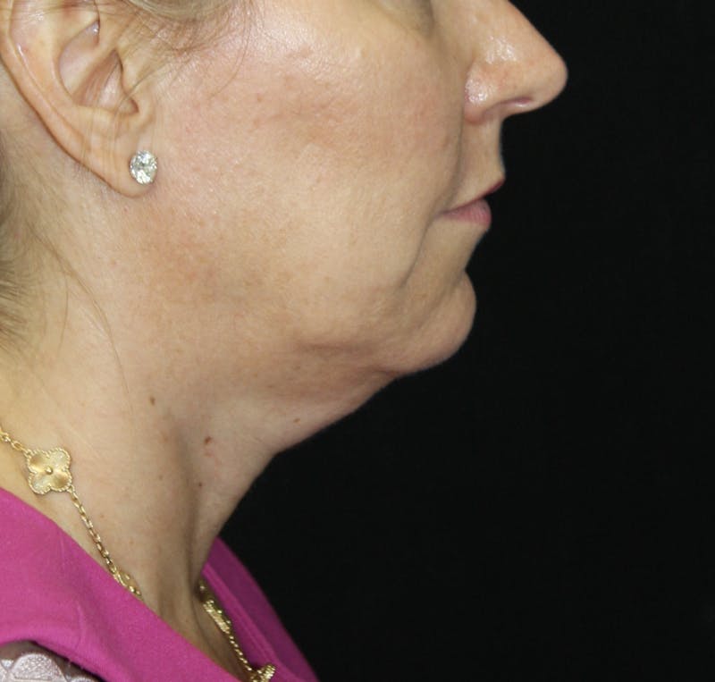 Facelift & Neck Lift Before & After Gallery - Patient 178281204 - Image 9