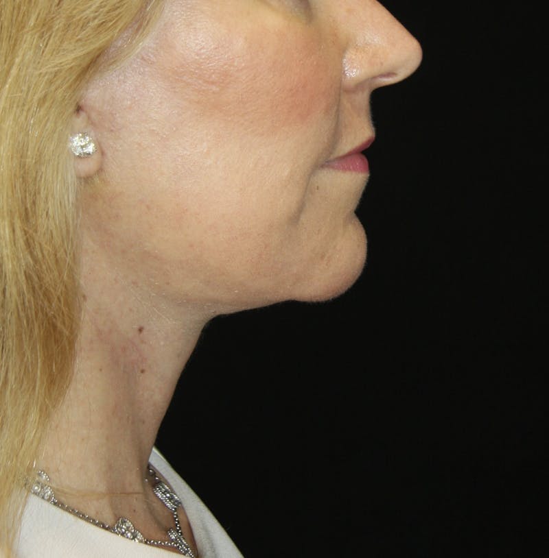 Facelift & Neck Lift Before & After Gallery - Patient 178281204 - Image 10