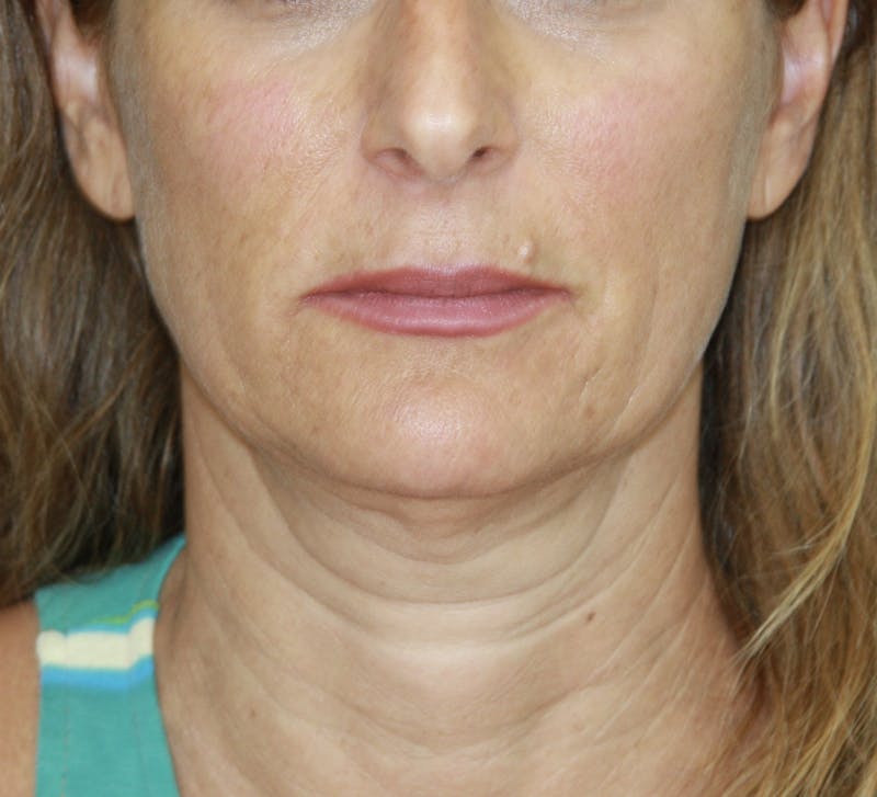 Facelift & Neck Lift Before & After Gallery - Patient 178285117 - Image 1