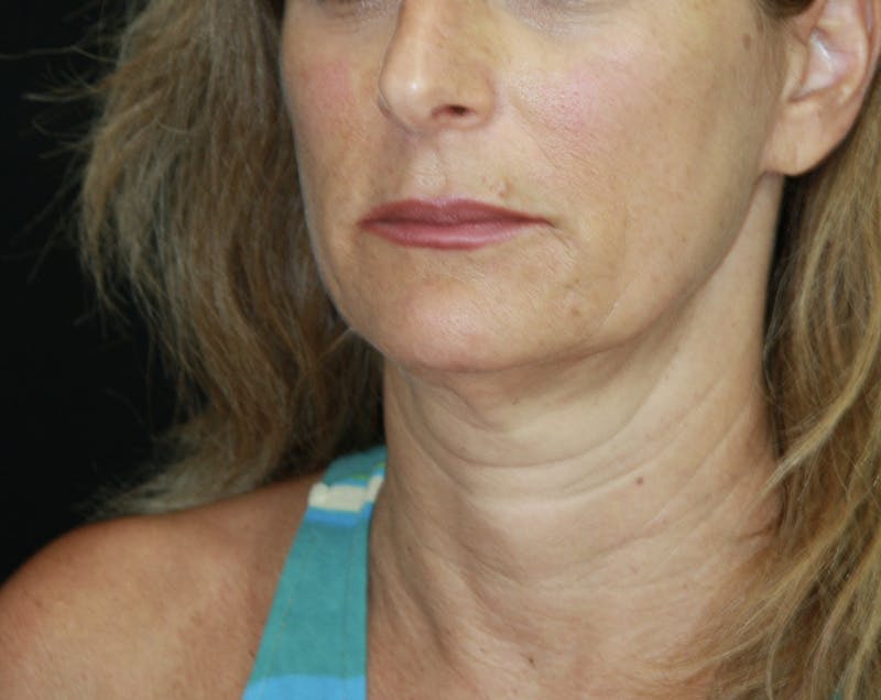 Facelift & Neck Lift Before & After Gallery - Patient 178285117 - Image 3