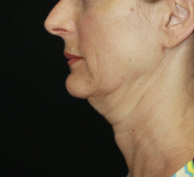 Facelift & Neck Lift Before & After Gallery - Patient 178285117 - Image 5