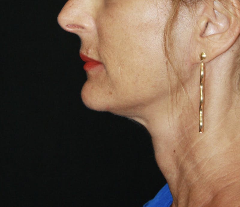 Facelift & Neck Lift Before & After Gallery - Patient 178285117 - Image 6