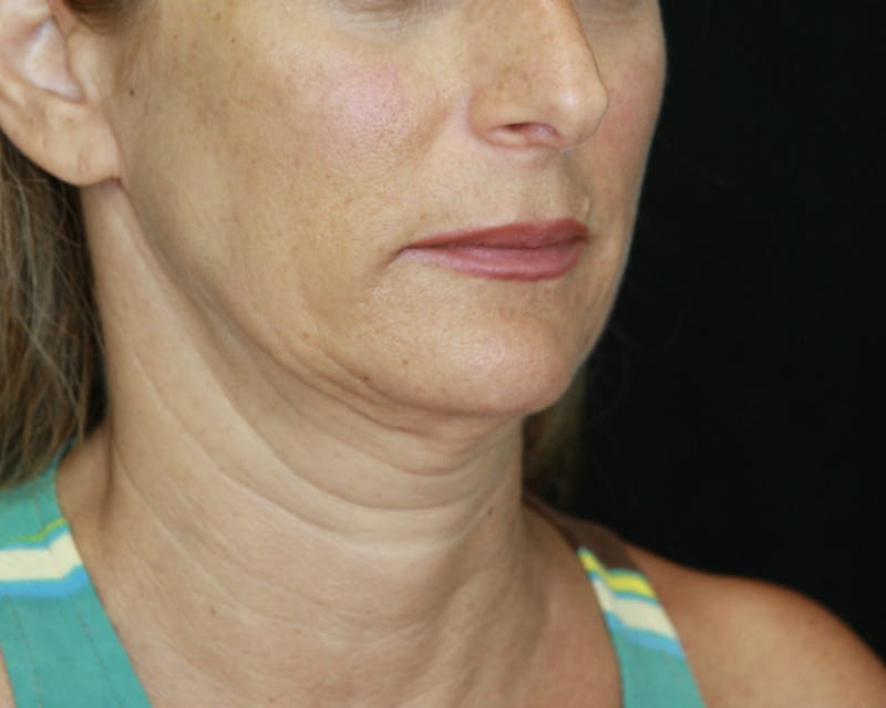 Facelift & Neck Lift Before & After Gallery - Patient 178285117 - Image 7