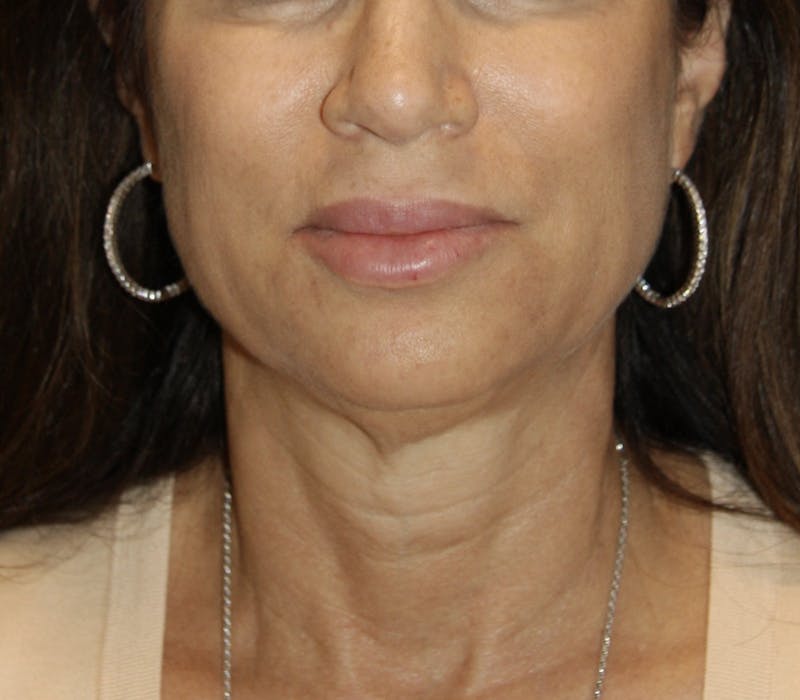 Facelift & Neck Lift Before & After Gallery - Patient 178285349 - Image 1