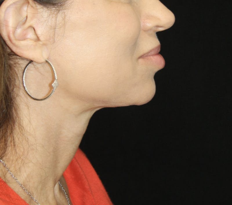 Facelift & Neck Lift Before & After Gallery - Patient 178285349 - Image 6