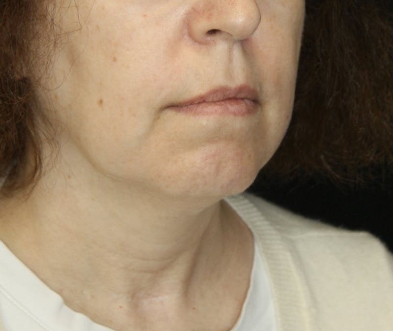 Facelift & Neck Lift Before & After Gallery - Patient 178285380 - Image 1