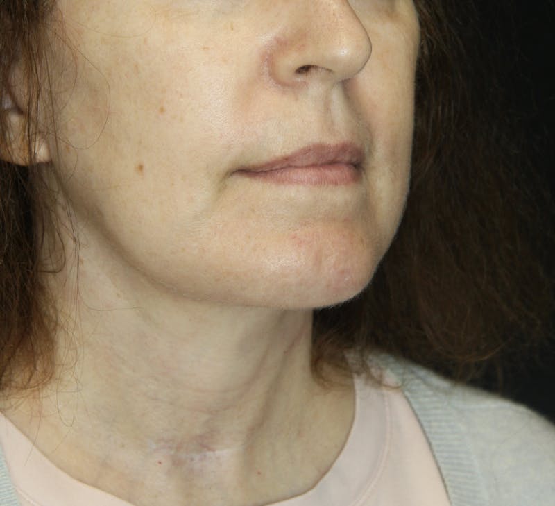 Facelift & Neck Lift Before & After Gallery - Patient 178285380 - Image 2