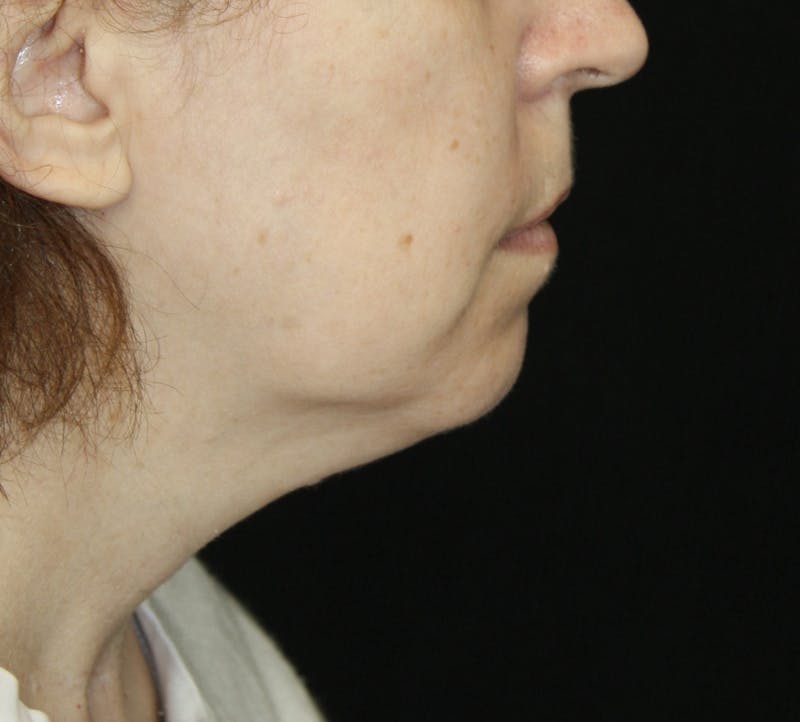 Facelift & Neck Lift Before & After Gallery - Patient 178285380 - Image 3