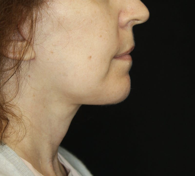 Facelift & Neck Lift Before & After Gallery - Patient 178285380 - Image 4