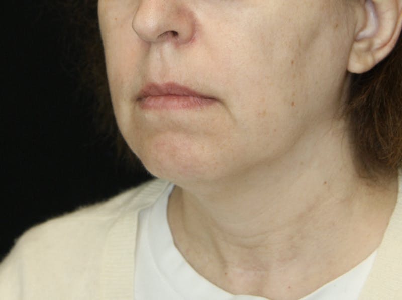 Facelift & Neck Lift Before & After Gallery - Patient 178285380 - Image 5