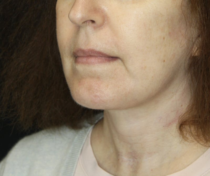 Facelift & Neck Lift Before & After Gallery - Patient 178285380 - Image 6
