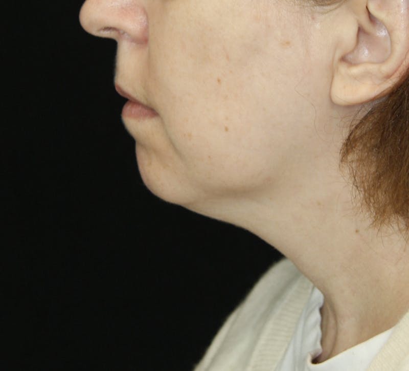 Facelift & Neck Lift Before & After Gallery - Patient 178285380 - Image 7