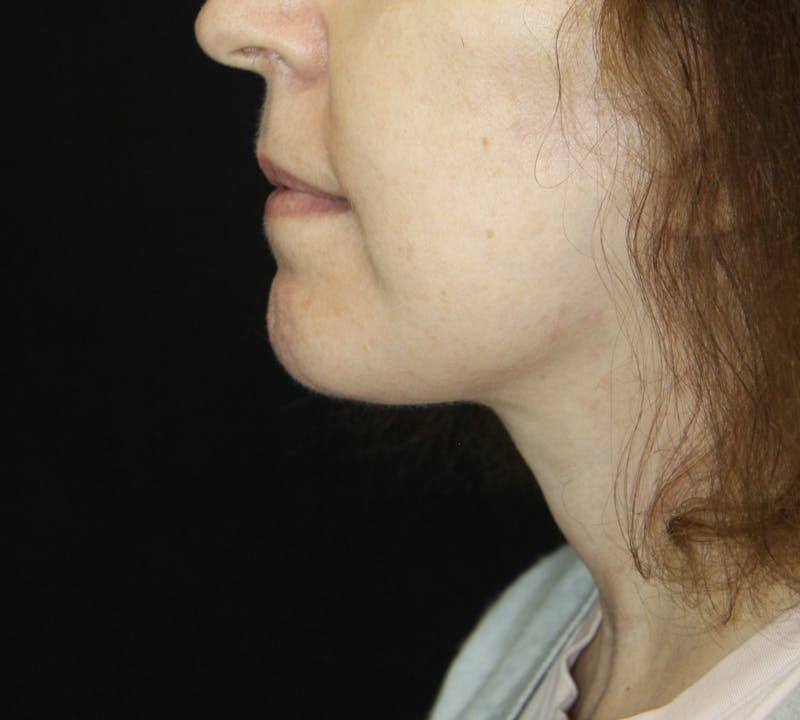 Facelift & Neck Lift Before & After Gallery - Patient 178285380 - Image 8