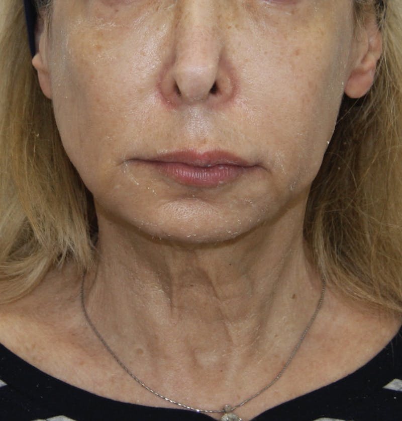 Facelift & Neck Lift Before & After Gallery - Patient 178285387 - Image 1
