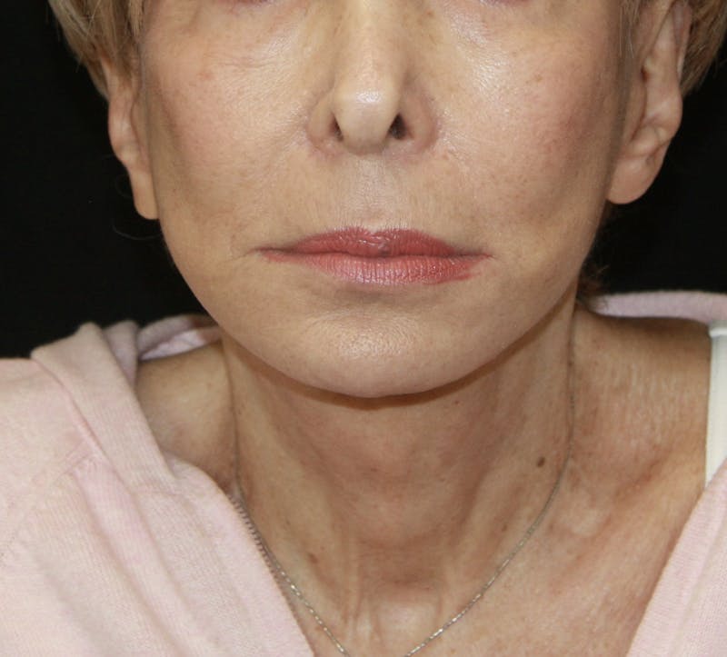 Facelift & Neck Lift Before & After Gallery - Patient 178285387 - Image 2