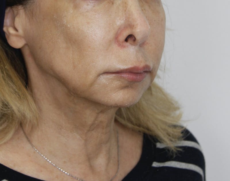 Facelift & Neck Lift Before & After Gallery - Patient 178285387 - Image 3