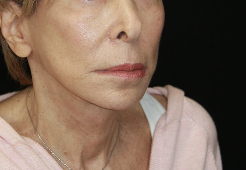 Facelift & Neck Lift Before & After Gallery - Patient 178285387 - Image 4