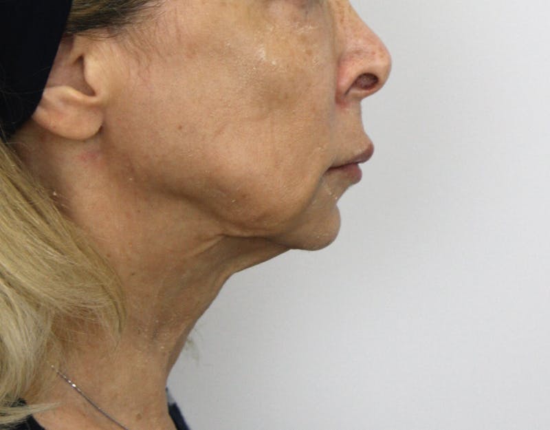 Facelift & Neck Lift Before & After Gallery - Patient 178285387 - Image 5