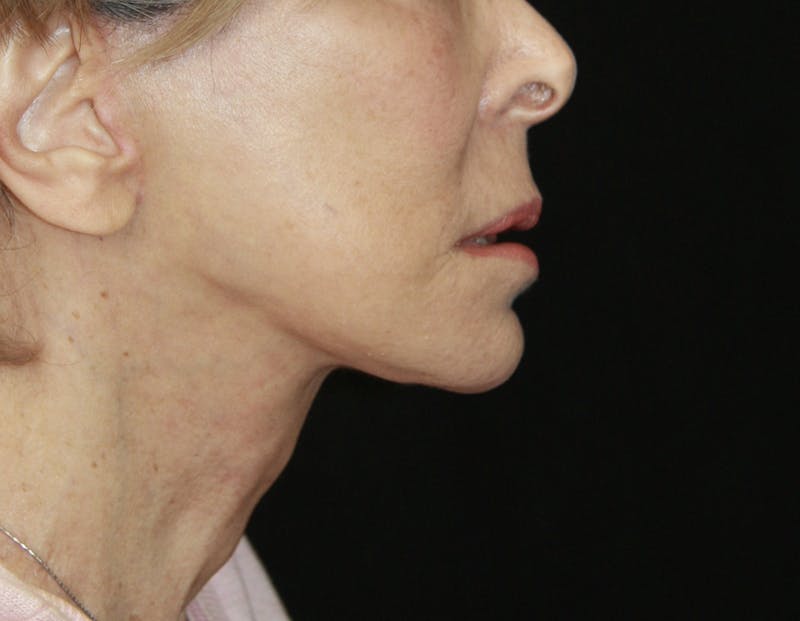 Facelift & Neck Lift Before & After Gallery - Patient 178285387 - Image 6