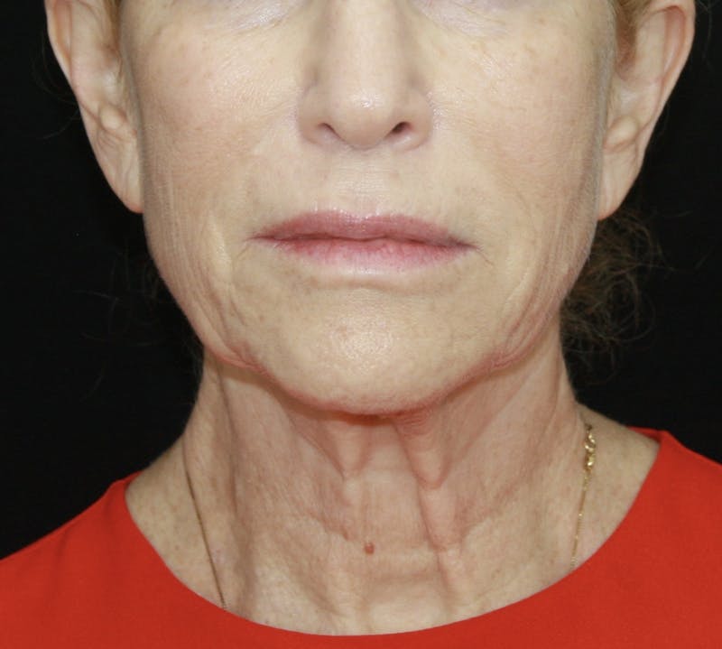 Facelift & Neck Lift Before & After Gallery - Patient 178287089 - Image 1
