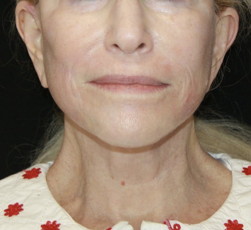 Facelift & Neck Lift Before & After Gallery - Patient 178287089 - Image 2
