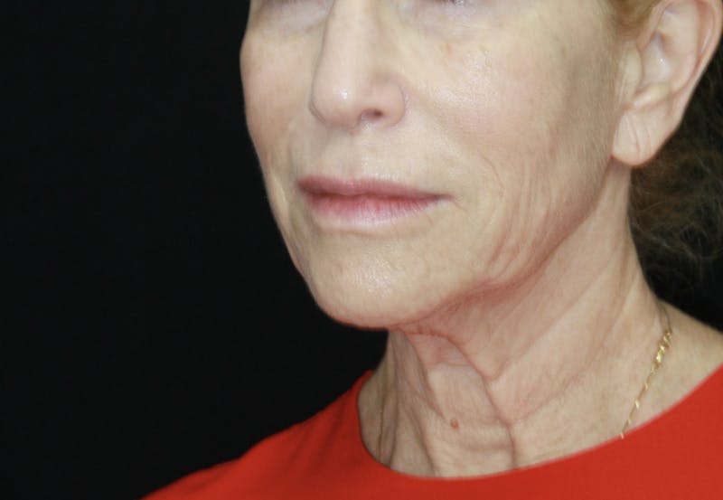 Facelift & Neck Lift Before & After Gallery - Patient 178287089 - Image 3