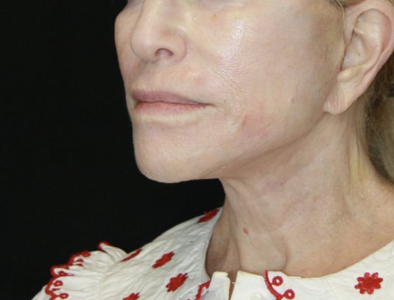 Facelift & Neck Lift Before & After Gallery - Patient 178287089 - Image 4