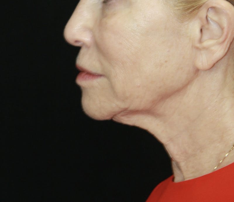 Facelift & Neck Lift Before & After Gallery - Patient 178287089 - Image 5