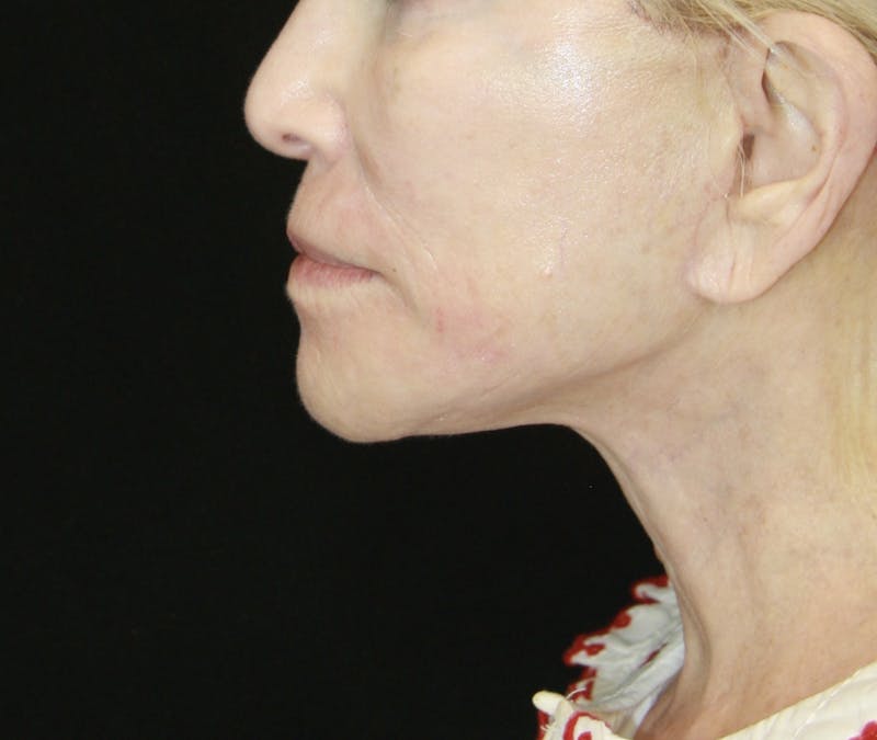 Facelift & Neck Lift Before & After Gallery - Patient 178287089 - Image 6