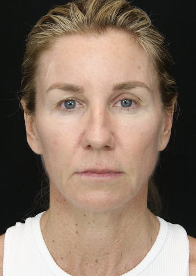 Facelift & Neck Lift Before & After Gallery - Patient 178287096 - Image 1