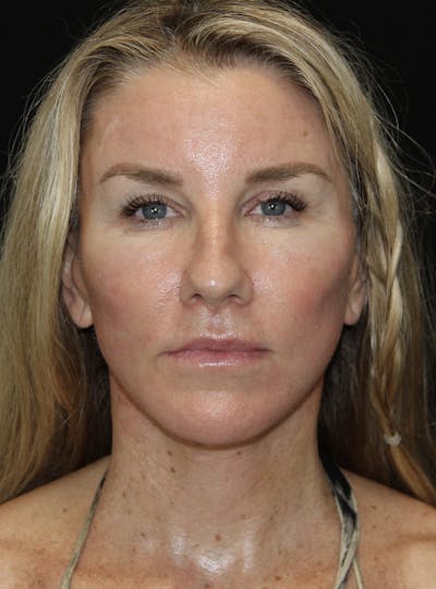 Facelift & Neck Lift Before & After Gallery - Patient 178287096 - Image 2