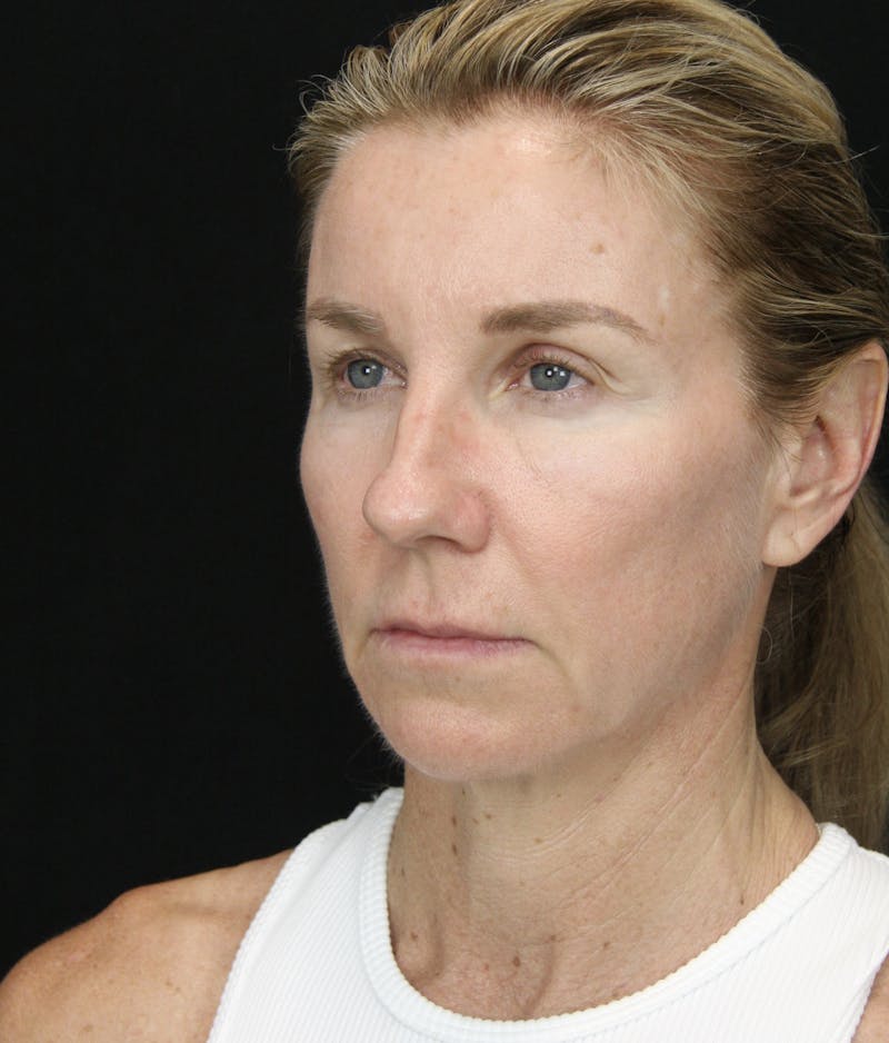 Facelift & Neck Lift Before & After Gallery - Patient 178287096 - Image 3