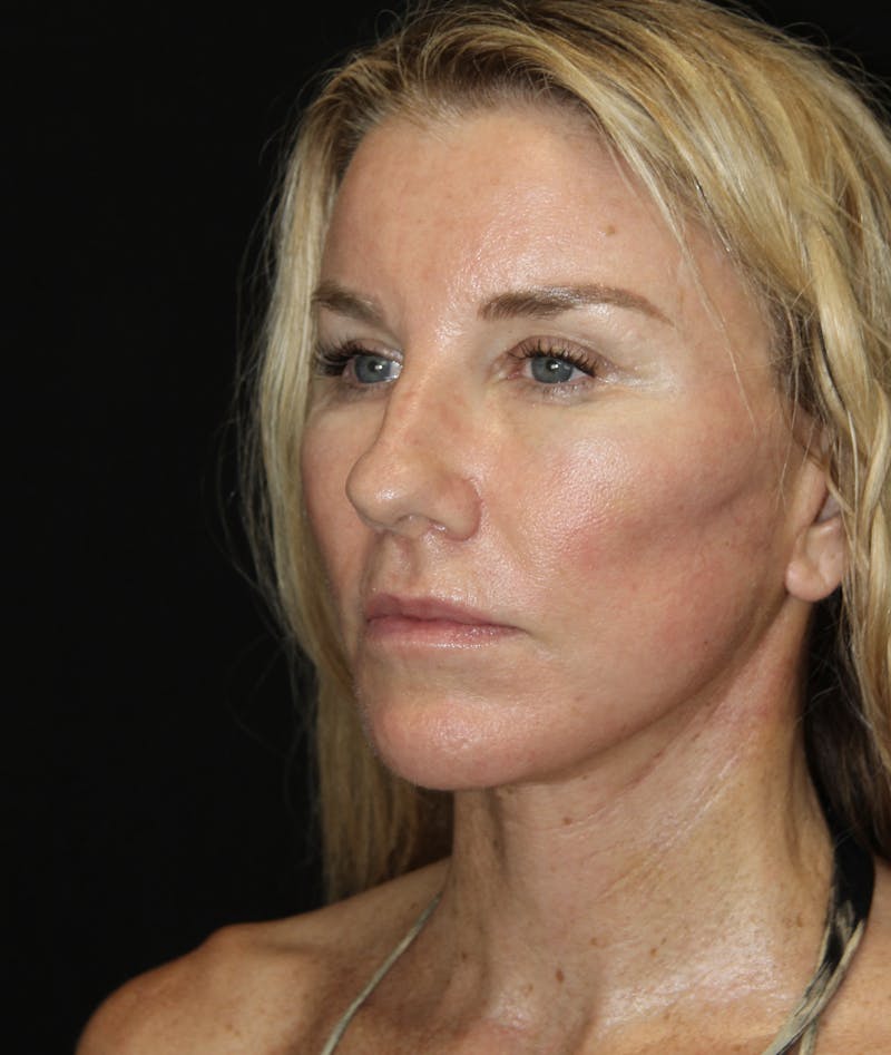 Facelift & Neck Lift Before & After Gallery - Patient 178287096 - Image 4