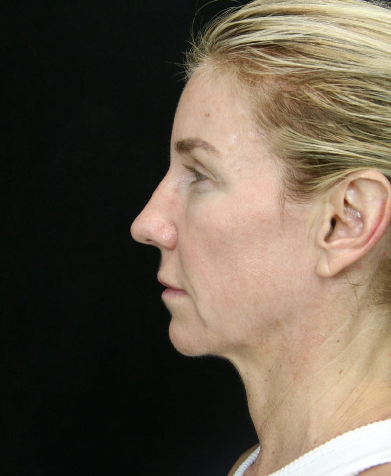 Facelift & Neck Lift Before & After Gallery - Patient 178287096 - Image 5