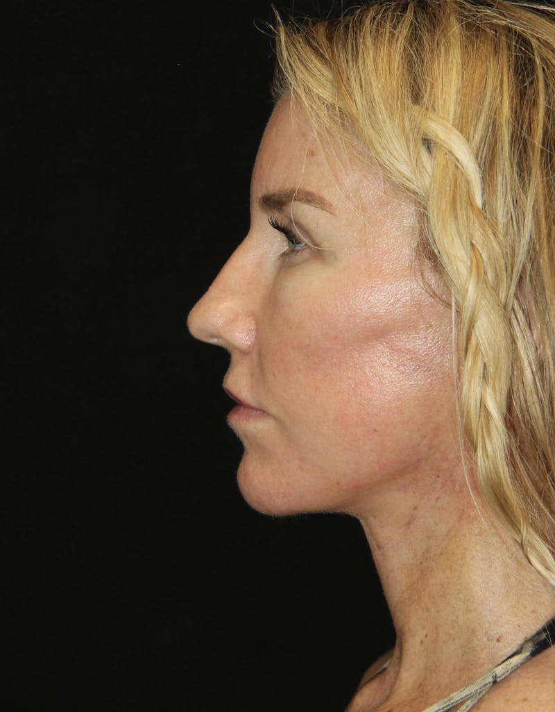 Facelift & Neck Lift Before & After Gallery - Patient 178287096 - Image 6