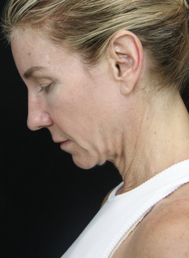 Facelift & Neck Lift Before & After Gallery - Patient 178287096 - Image 7