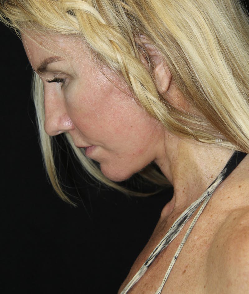 Facelift & Neck Lift Before & After Gallery - Patient 178287096 - Image 8