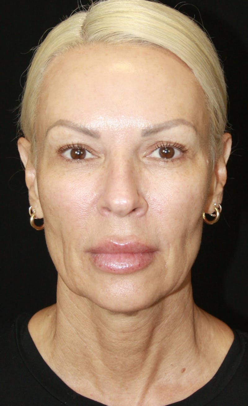 Facelift & Neck Lift Before & After Gallery - Patient 178287179 - Image 1