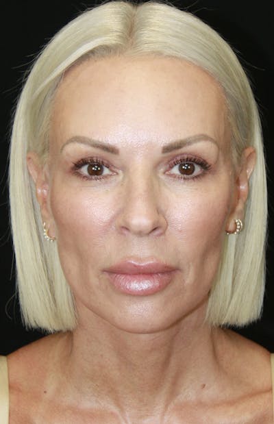 Facelift & Neck Lift Before & After Gallery - Patient 178287179 - Image 2