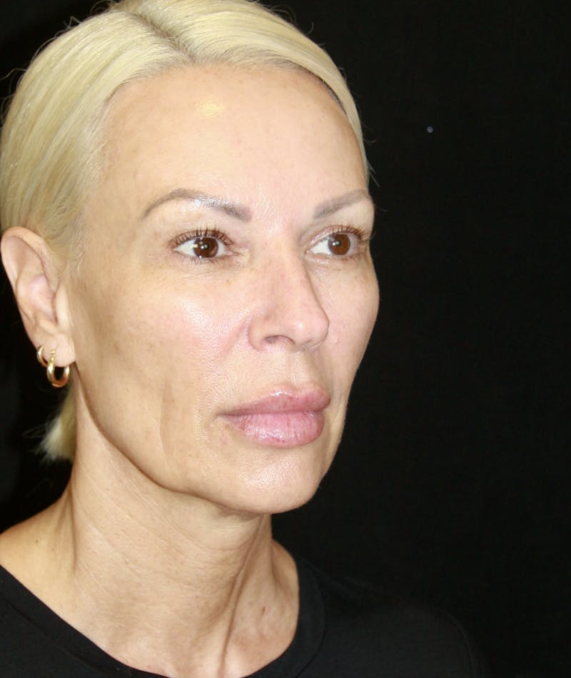 Facelift & Neck Lift Before & After Gallery - Patient 178287179 - Image 3