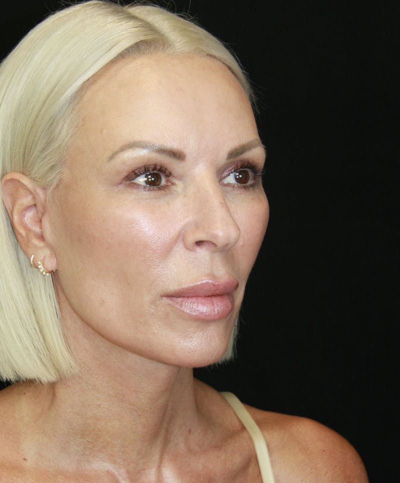 Facelift & Neck Lift Before & After Gallery - Patient 178287179 - Image 4