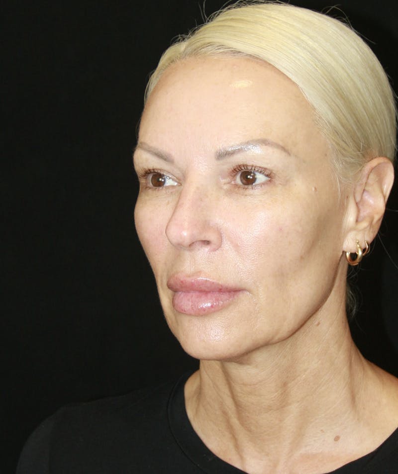 Facelift & Neck Lift Before & After Gallery - Patient 178287179 - Image 5